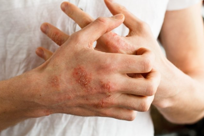 Eczema Explained: What’s New in Treatments for 2024